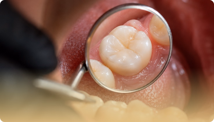 Composite Fillings