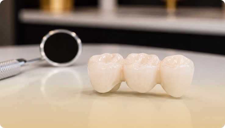 Dental Bridges