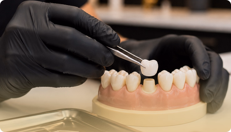 Dental Crowns