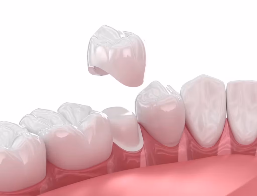 dental crowns in San Antonio showing crown placement to restore and protect damaged teeth