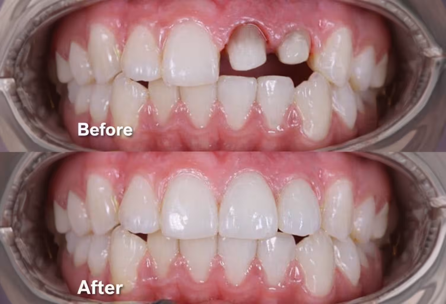 before and after dental crowns in San Antonio showing restored teeth and improved smile appearance