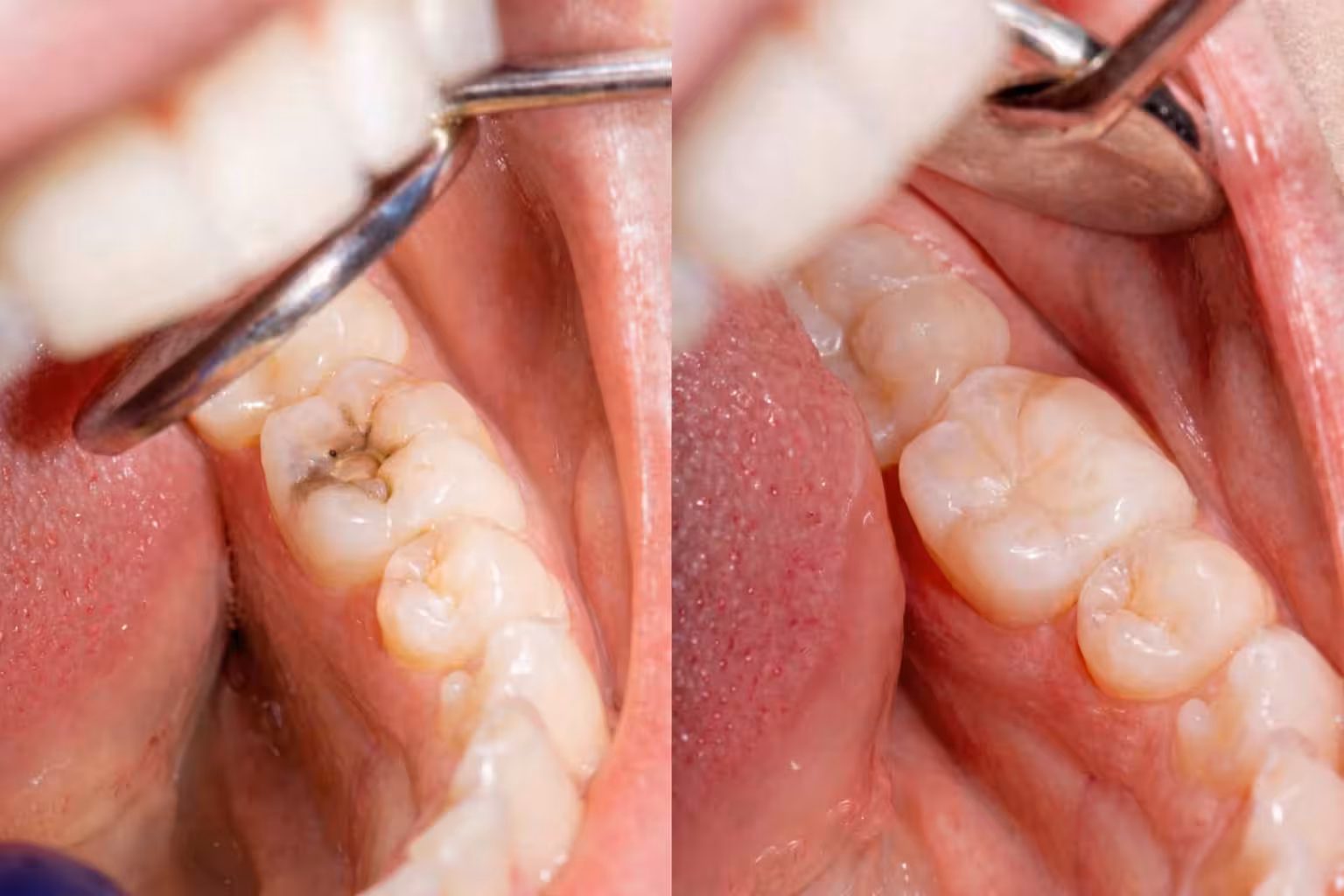 before and after composite filling treatment restoring decayed tooth with natural tooth colored material