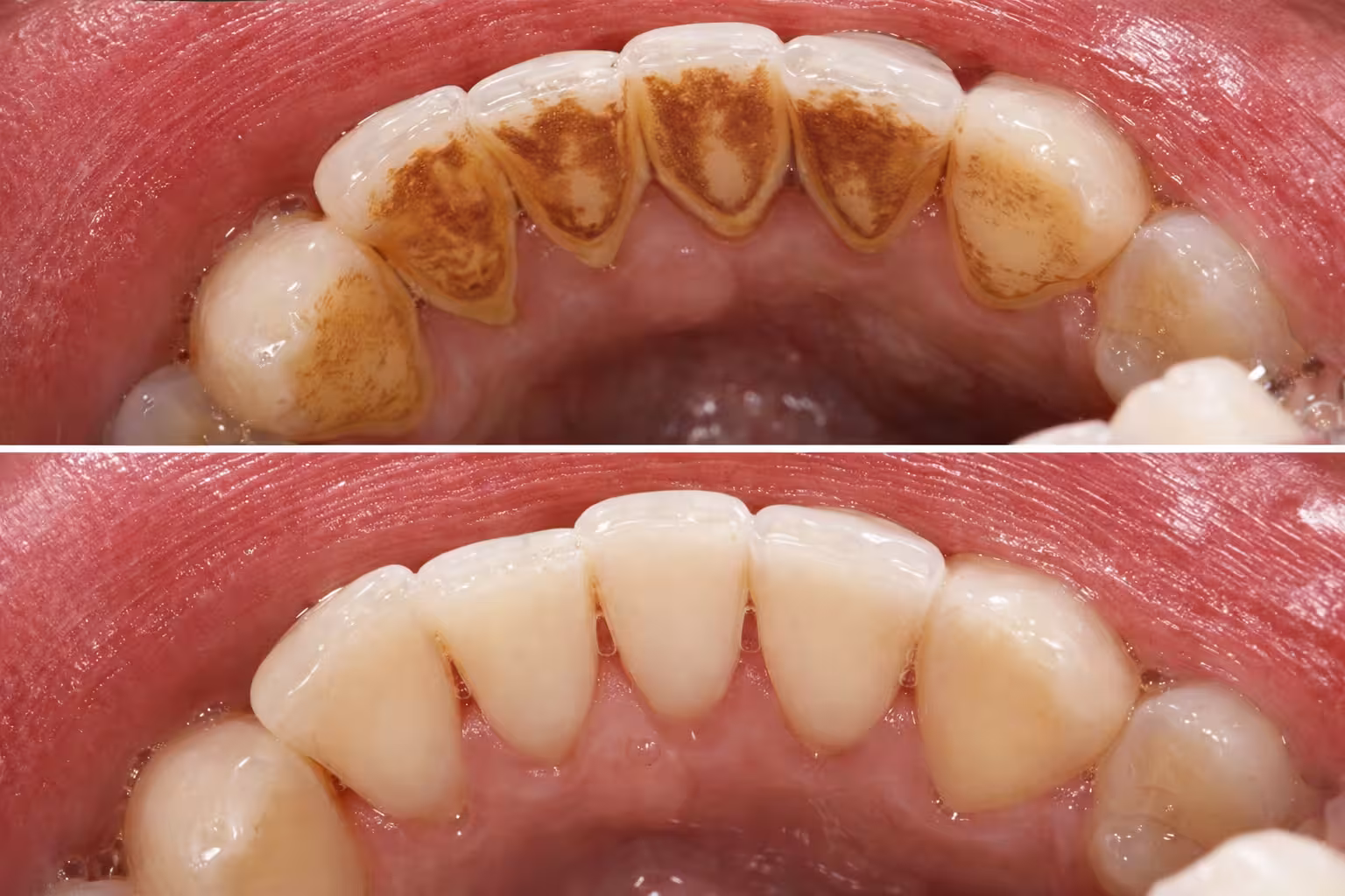 before and after deep cleaning removing plaque and tartar buildup from teeth and gums