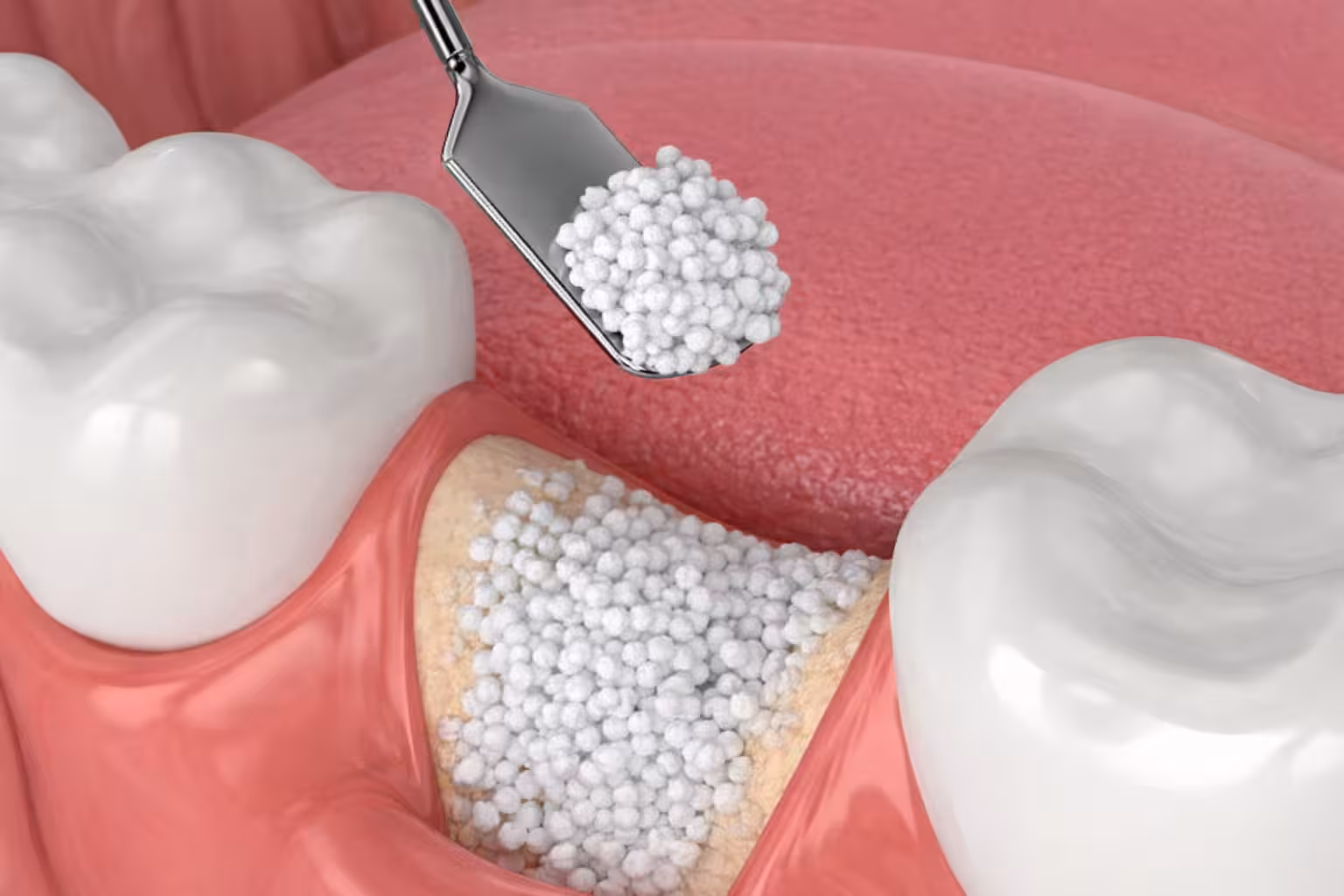 dental bone graft procedure placing graft material into jawbone socket for tooth support and regeneration