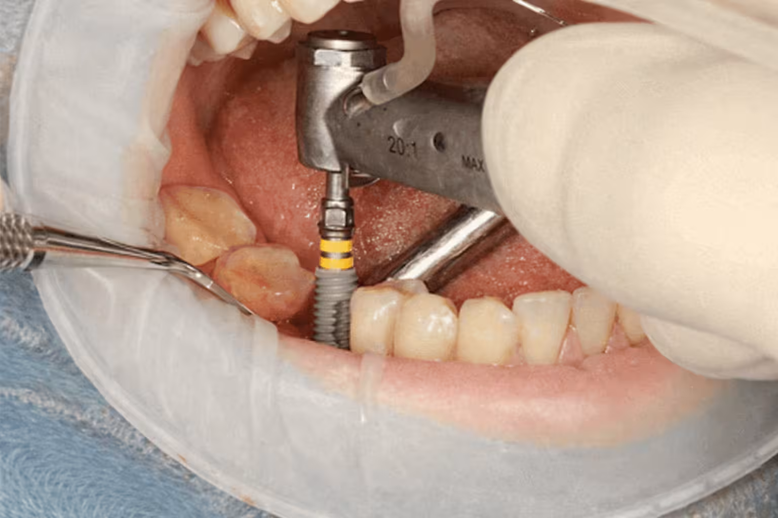 dentist performing dental implant restoration by placing abutment and crown using surgical tool in patient mouth