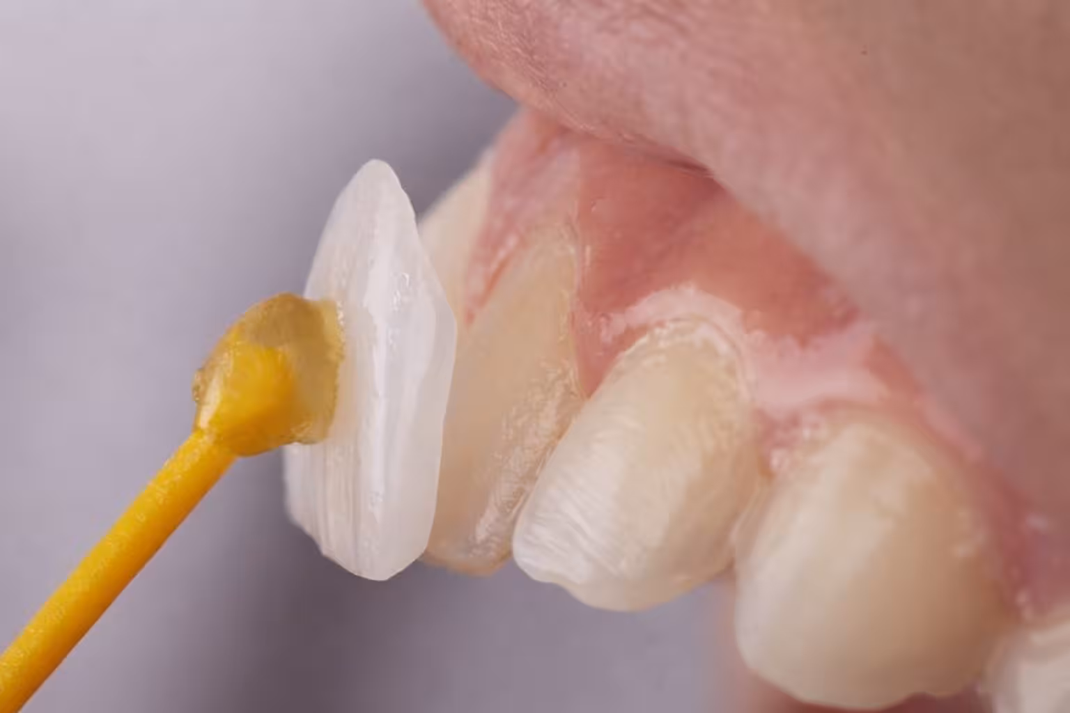 dental veneers application in San Antonio showing placement of porcelain veneer on tooth