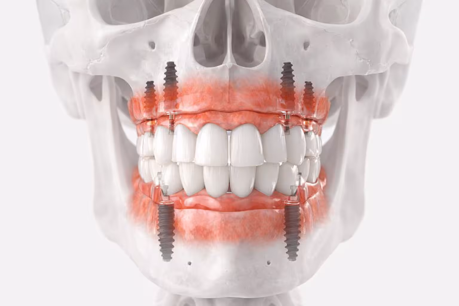 full arch dental implants placed in upper and lower jaw showing multiple titanium posts supporting complete teeth restoration
