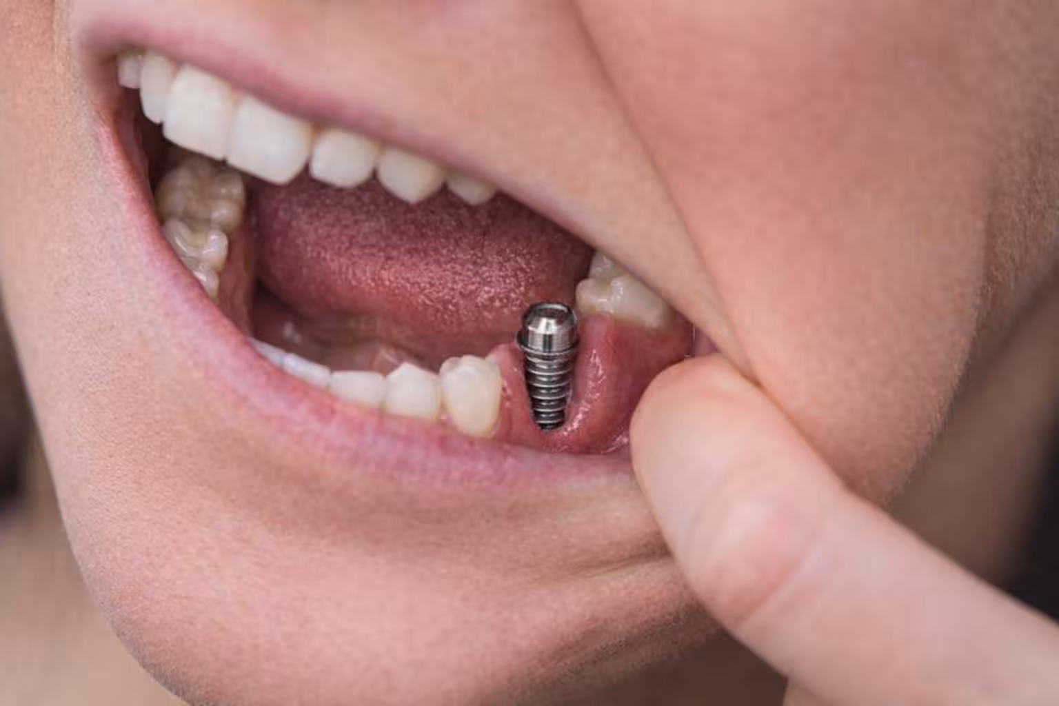 single tooth implant visible in jaw with exposed titanium post replacing missing tooth