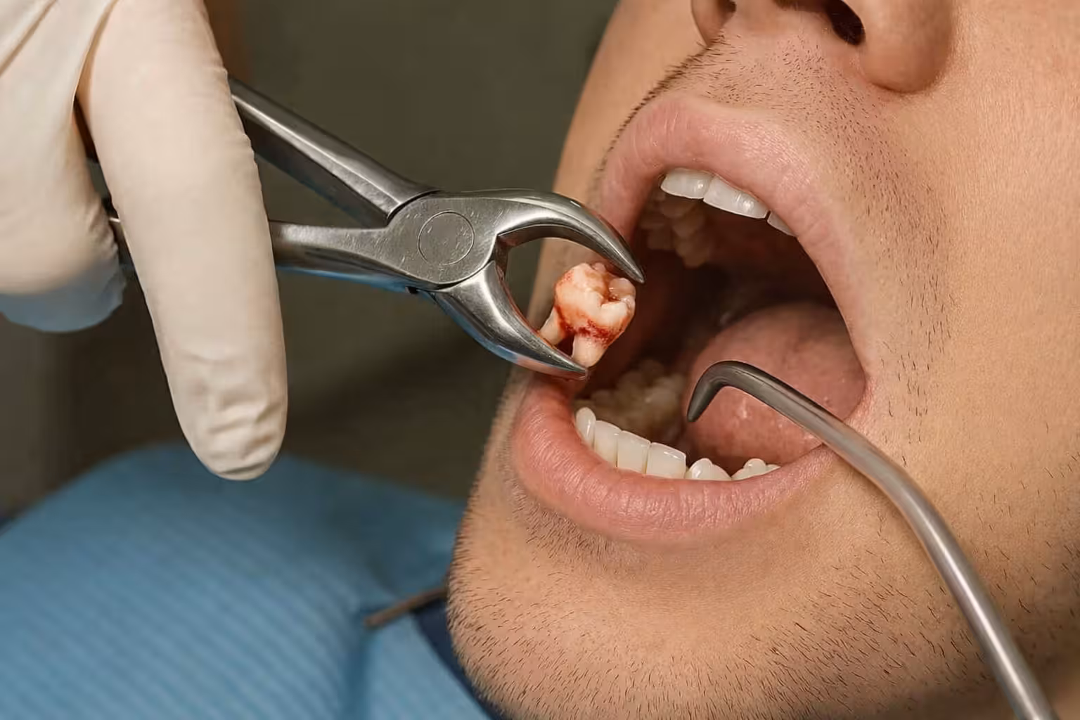 dentist extracting tooth using forceps during oral surgery procedure with patient in dental chair