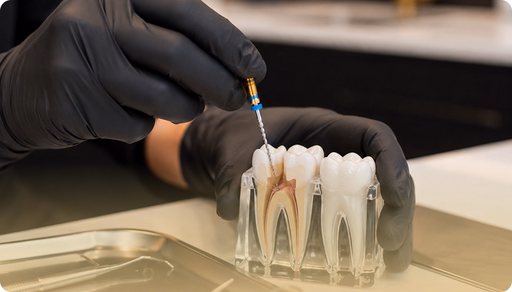 Root Canal Treatment