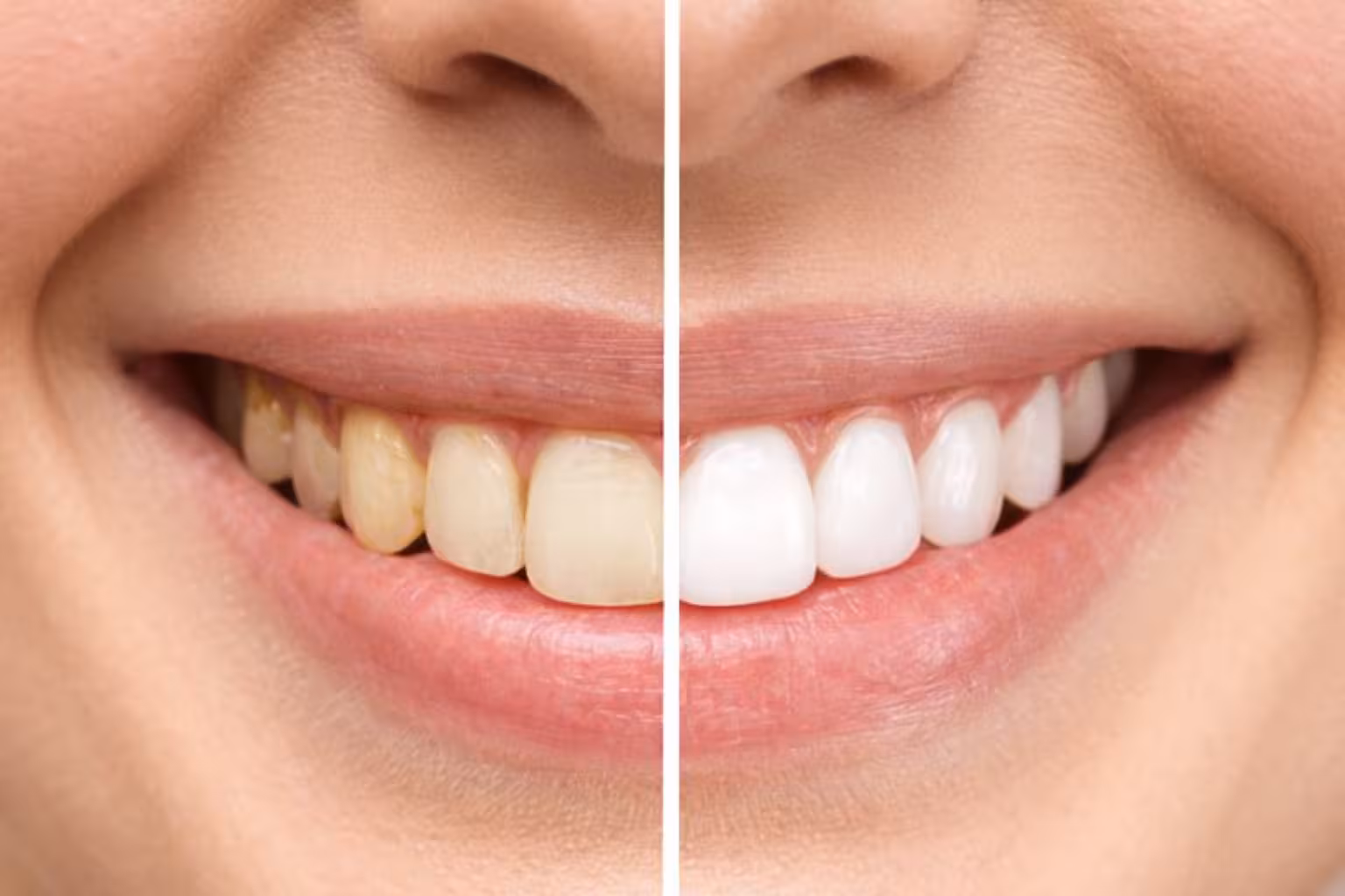 dental cleaning and exam in San Antonio showing before and after healthy smile results