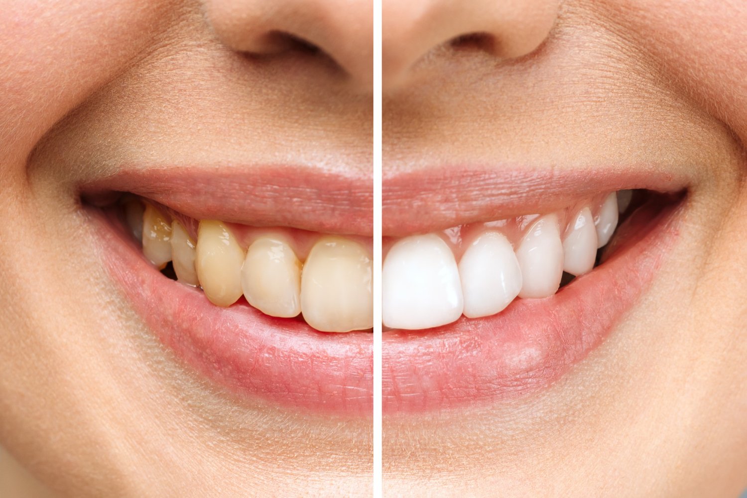 teeth whitening san antonio hero image