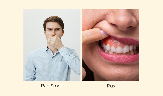 Stage 2 Days 3 to 7 – Early Recovery