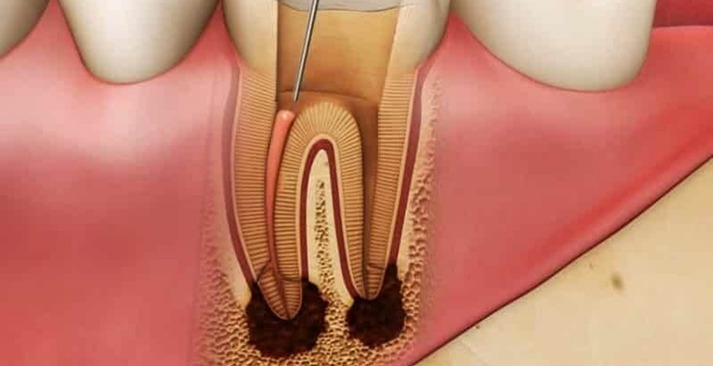 Tooth with leaking root canal and instrument inside pulp chamber.
