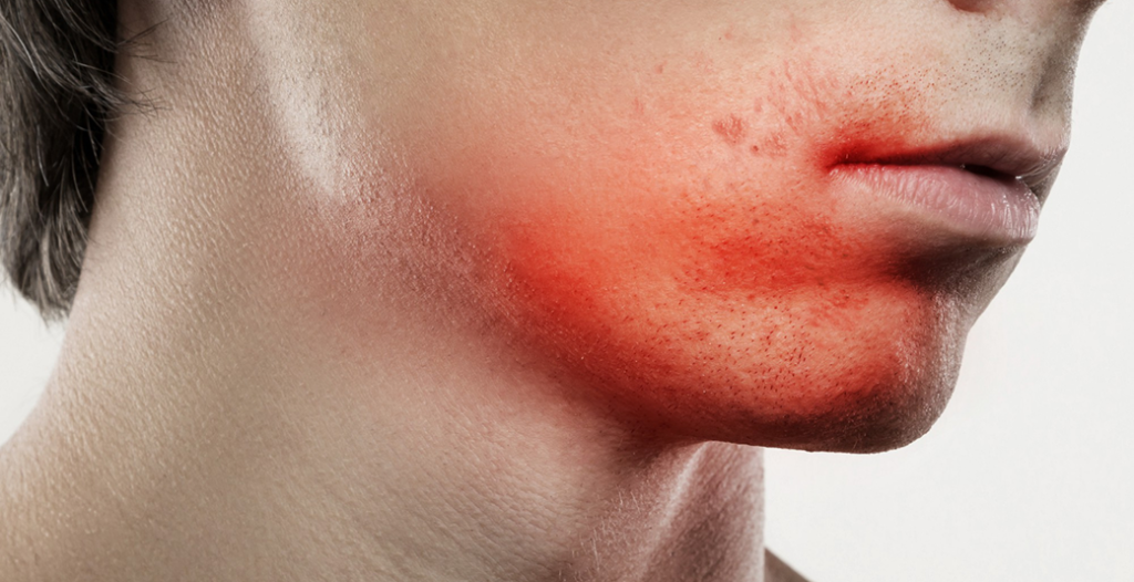 Red, irritated jawline suggesting possible dental infection.