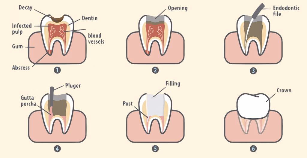 Root canal procedure steps from decay to crown placement