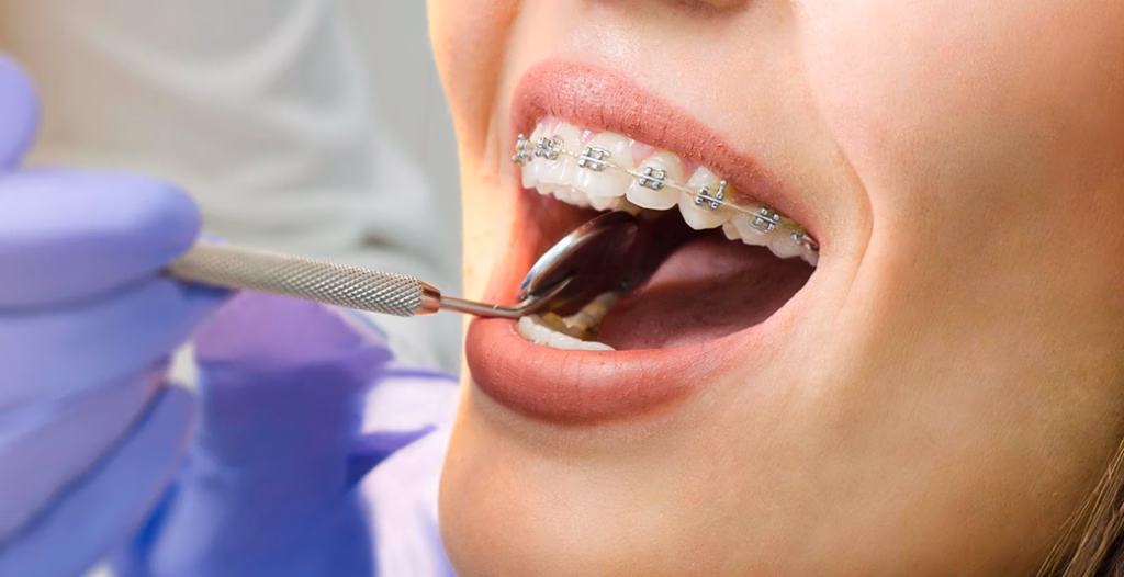 Close-up of a person with metal braces having their teeth examined with a dental mirror by a gloved professional.