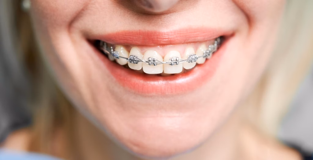 Pros and Cons of Braces