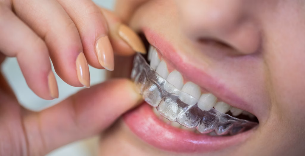 Close-up of a person placing a clear dental aligner over their upper teeth using their fingers.