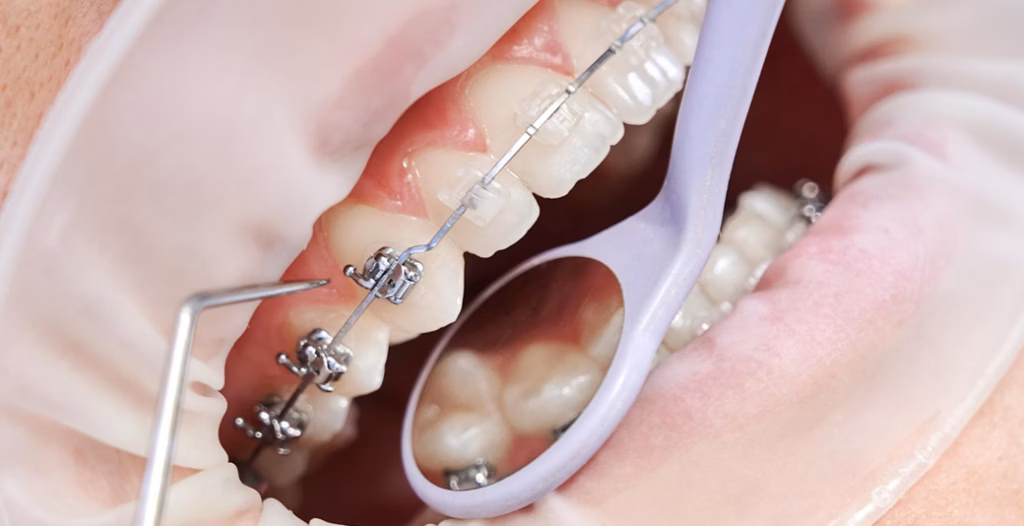Dental check-up showing braces on upper and lower teeth with a mirror and probe inspecting alignment.