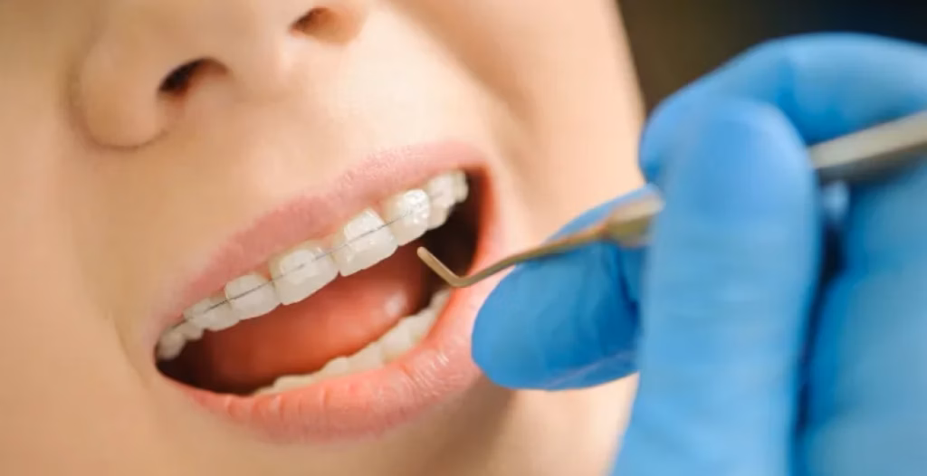 Gloved hand holding tool examines ceramic braces on upper teeth during close-up dental checkup.