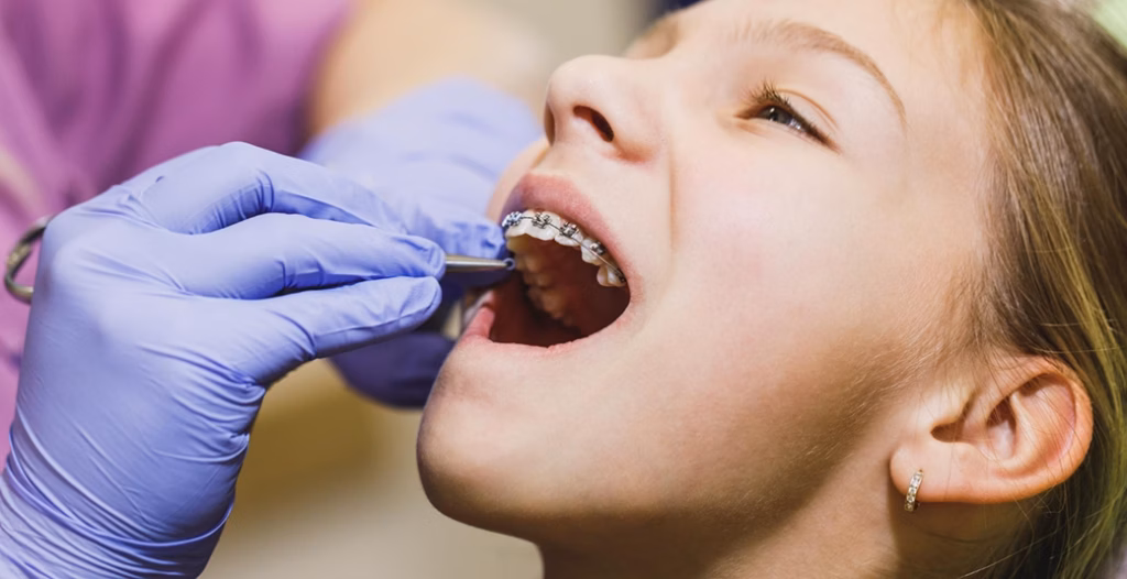 Dentist in blue gloves adjusting metal braces inside patient&rsquo;s open mouth during orthodontic checkup.