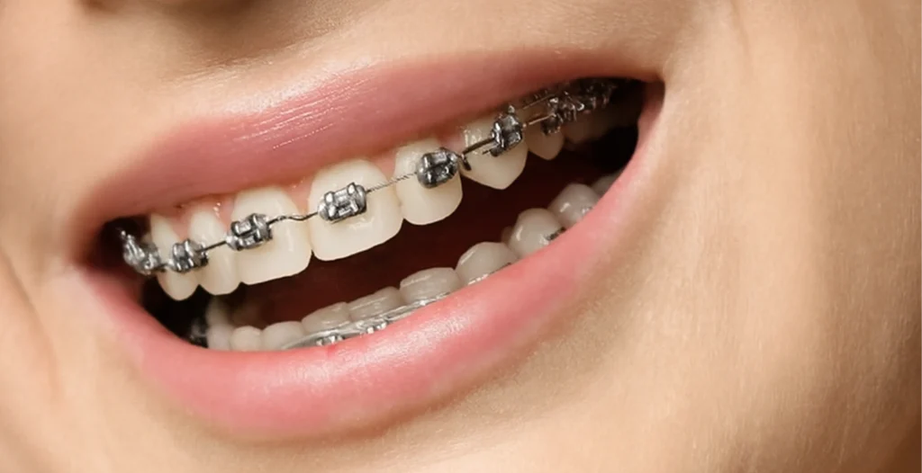 Close-up of a smiling mouth with metal braces on upper and lower teeth, showing brackets and archwire.