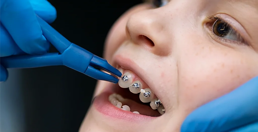 Child receiving orthodontic care as dentist removes metal braces with dental tool and blue gloves.