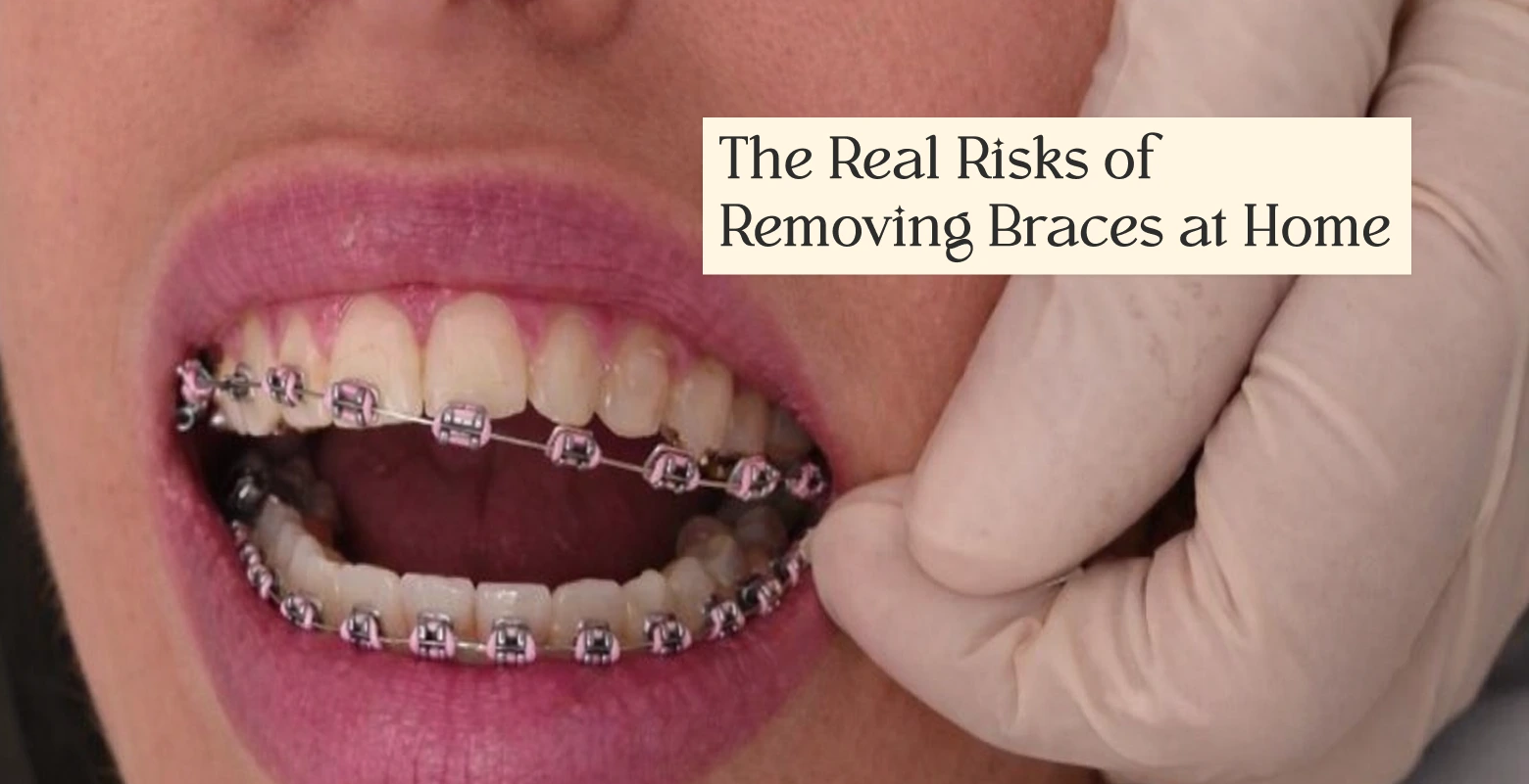 How to Remove a Brace at Home