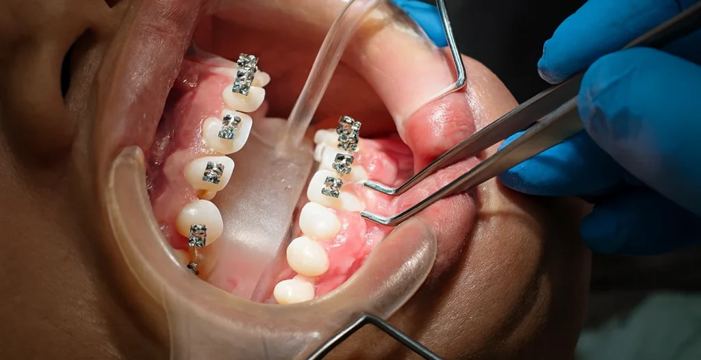 Orthodontic procedure with dental retractor, metal braces, and dentist removing wires using tweezers.