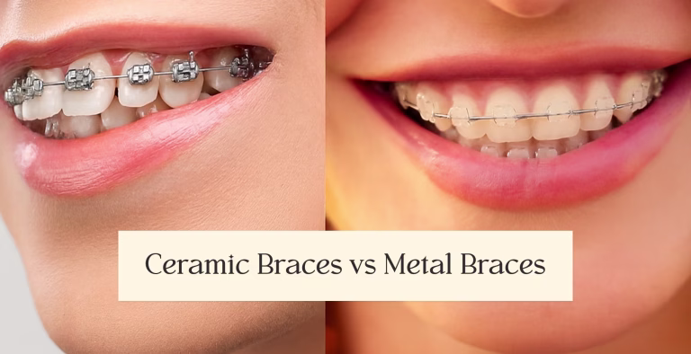 Side-by-side comparison of ceramic braces with clear brackets and metal braces with noticeable metallic brackets