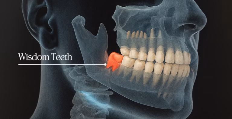 Medical illustration of skull showing wisdom tooth highlighted in red at back of jaw