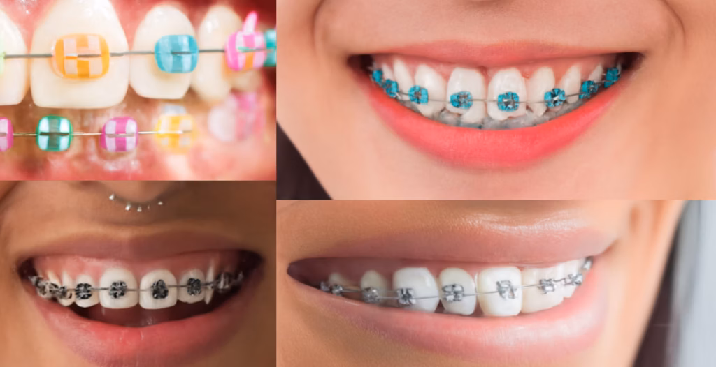 Collage of dental braces with colorful, patterned, turquoise, and silver elastic bands.