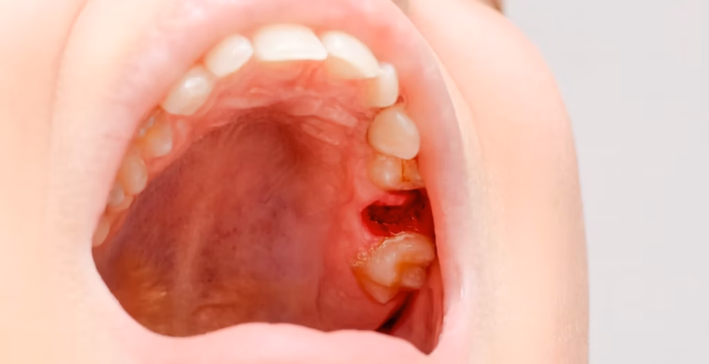 Healing hole in upper gum after wisdom tooth extraction, with surrounding teeth and pink oral tissue