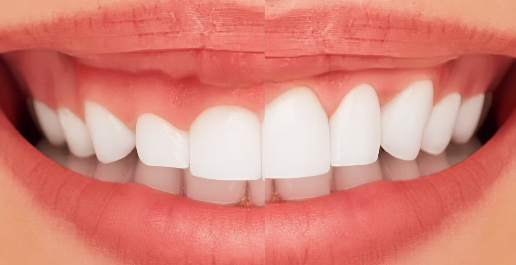 Close-up of teeth showing natural alignment on left and cosmetic dental treatment with veneers on right.