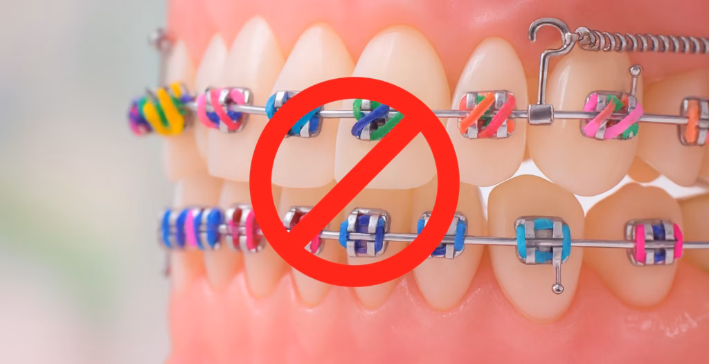 Dental model with colorful braces and red prohibition symbol indicating restriction.