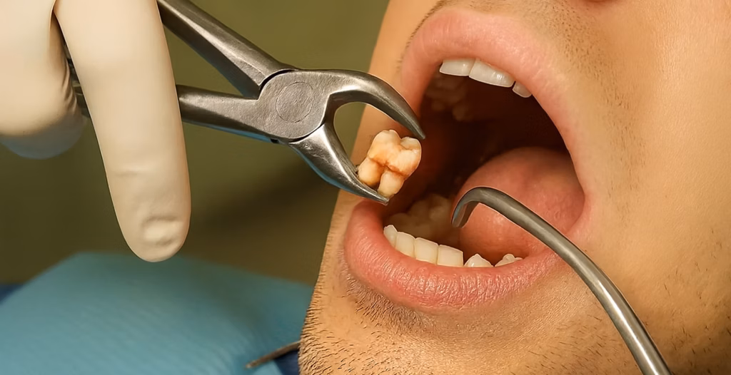 Dentist extracting molar with forceps during procedure, suction tool visible, blood on tooth root.