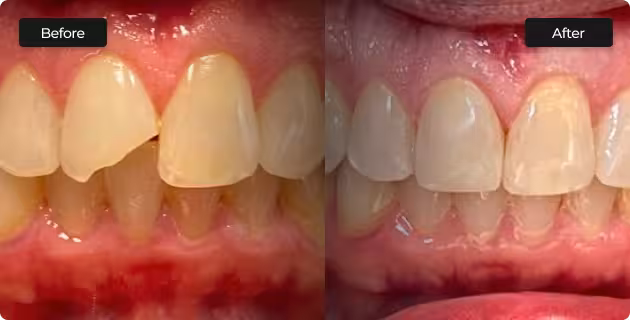 before and after cosmetic dentistry results in San Antonio showing improved gum health and brighter smile
