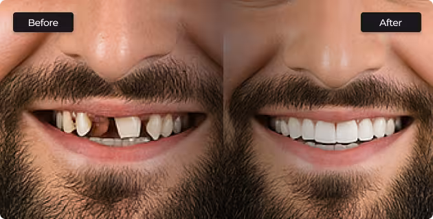 before and after dental restoration in San Antonio showing missing teeth replaced with natural looking smile