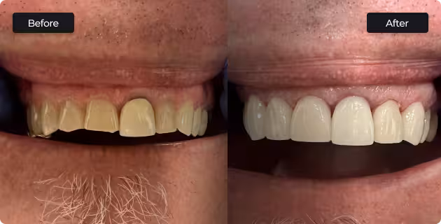 before and after teeth whitening in San Antonio showing brighter and more even smile results
