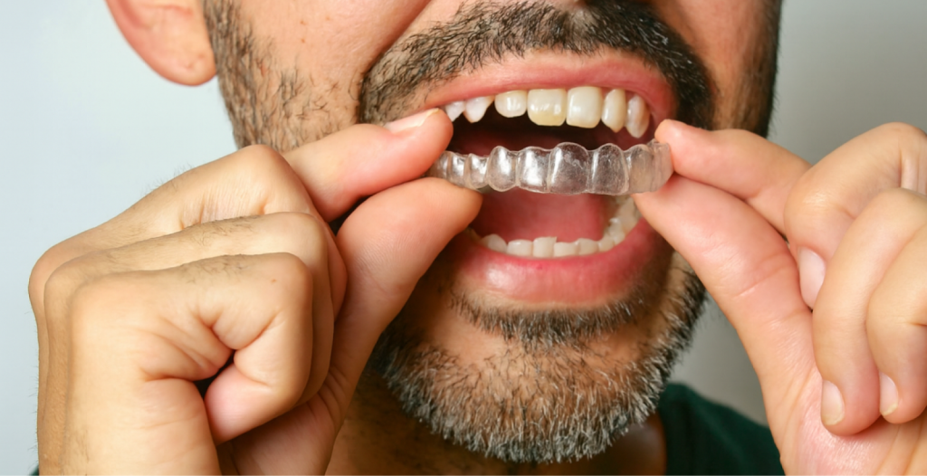 Person inserting a clear dental aligner onto upper teeth using both hands, showing clean, well-aligned teeth.