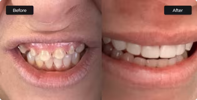 smile transformation in San Antonio with cosmetic dentist showing before and after teeth alignment and whitening results