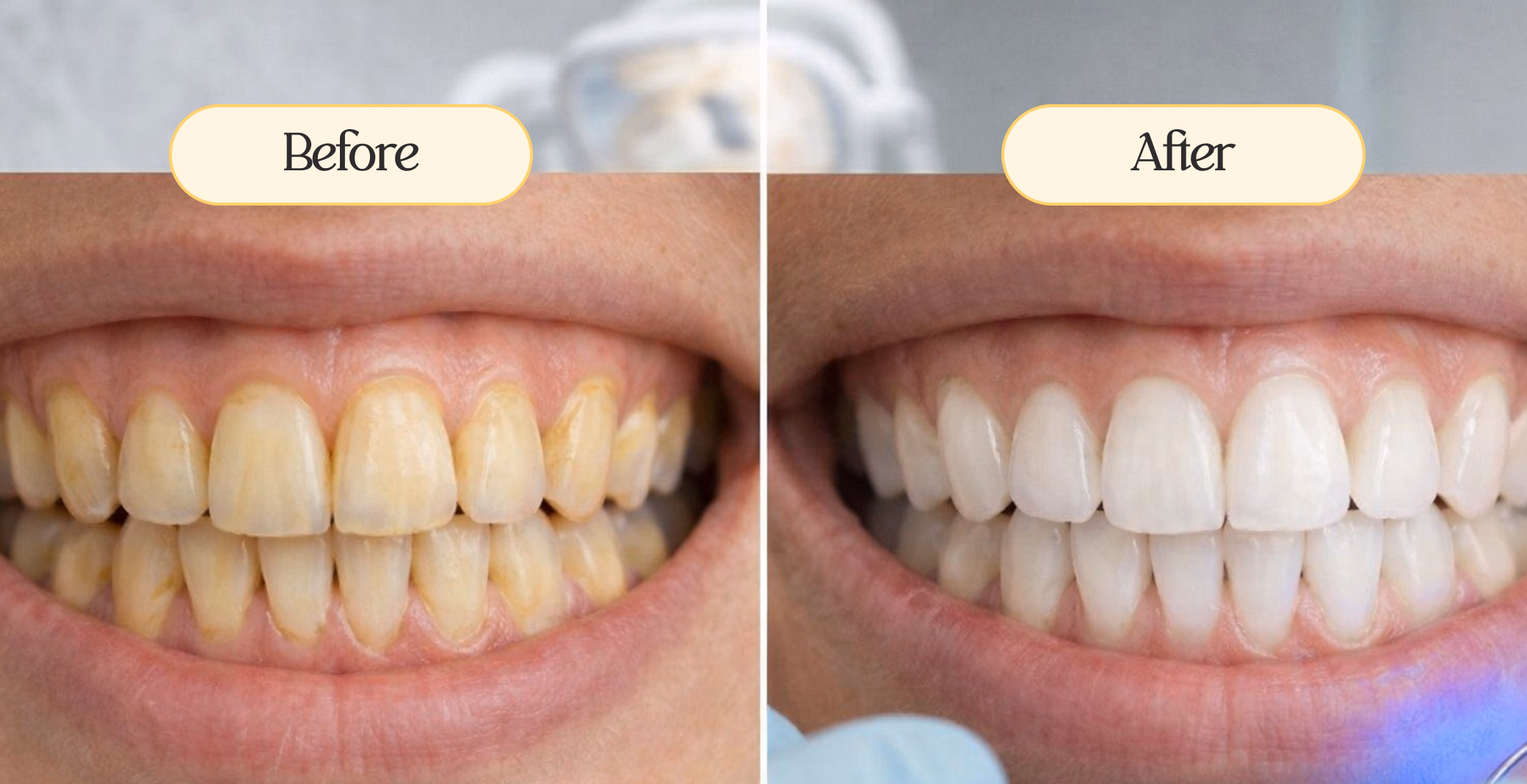 Close-up comparison of teeth before and after whitening showing yellowed teeth transformed into bright white teeth.