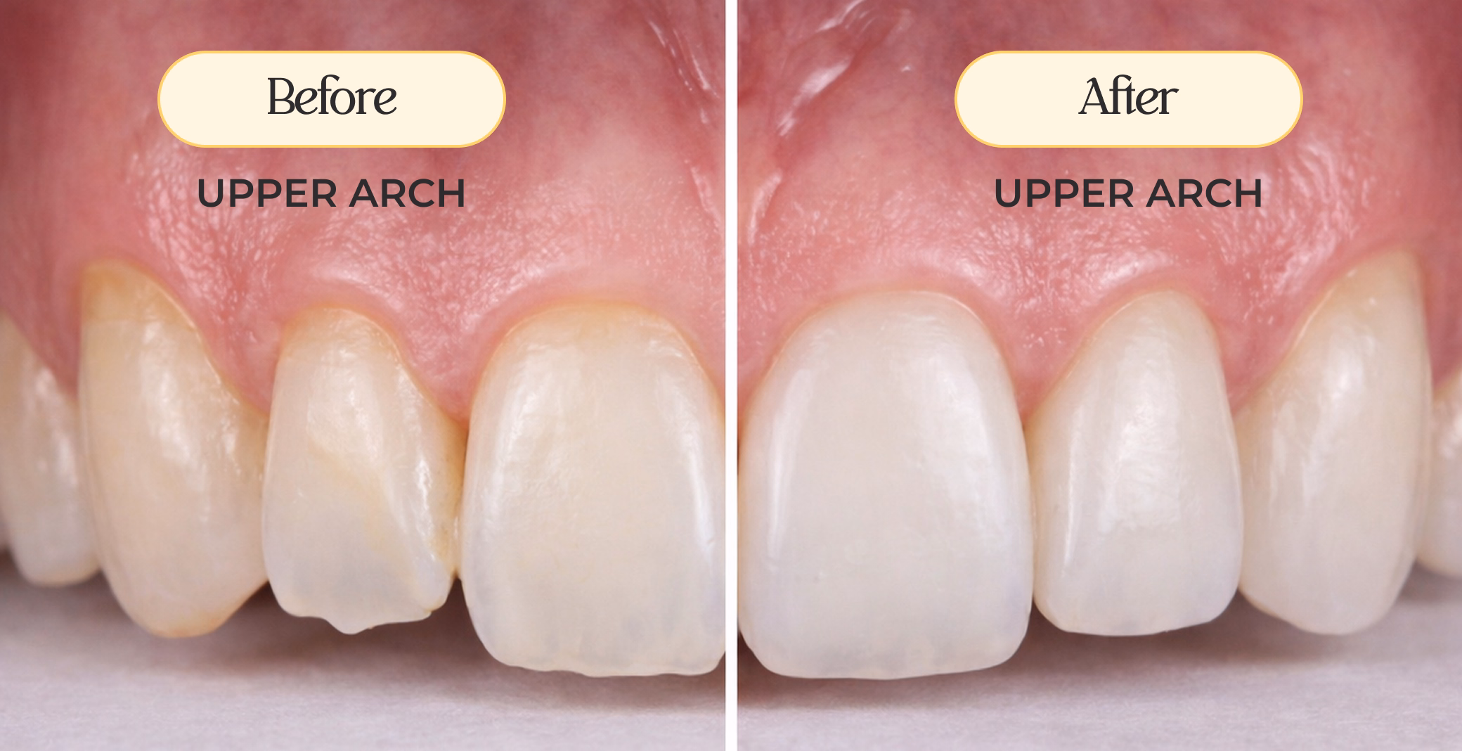 Close-up comparison of upper front teeth before and after veneers showing whiter, smoother, and even results.