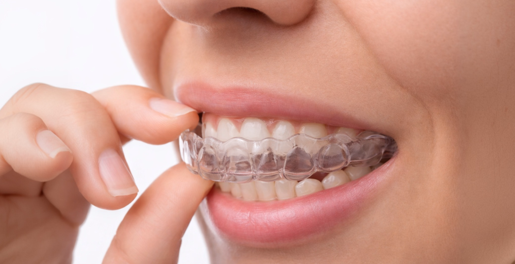 Clear dental aligner being placed on upper teeth showing transparent fit over clean, white teeth.