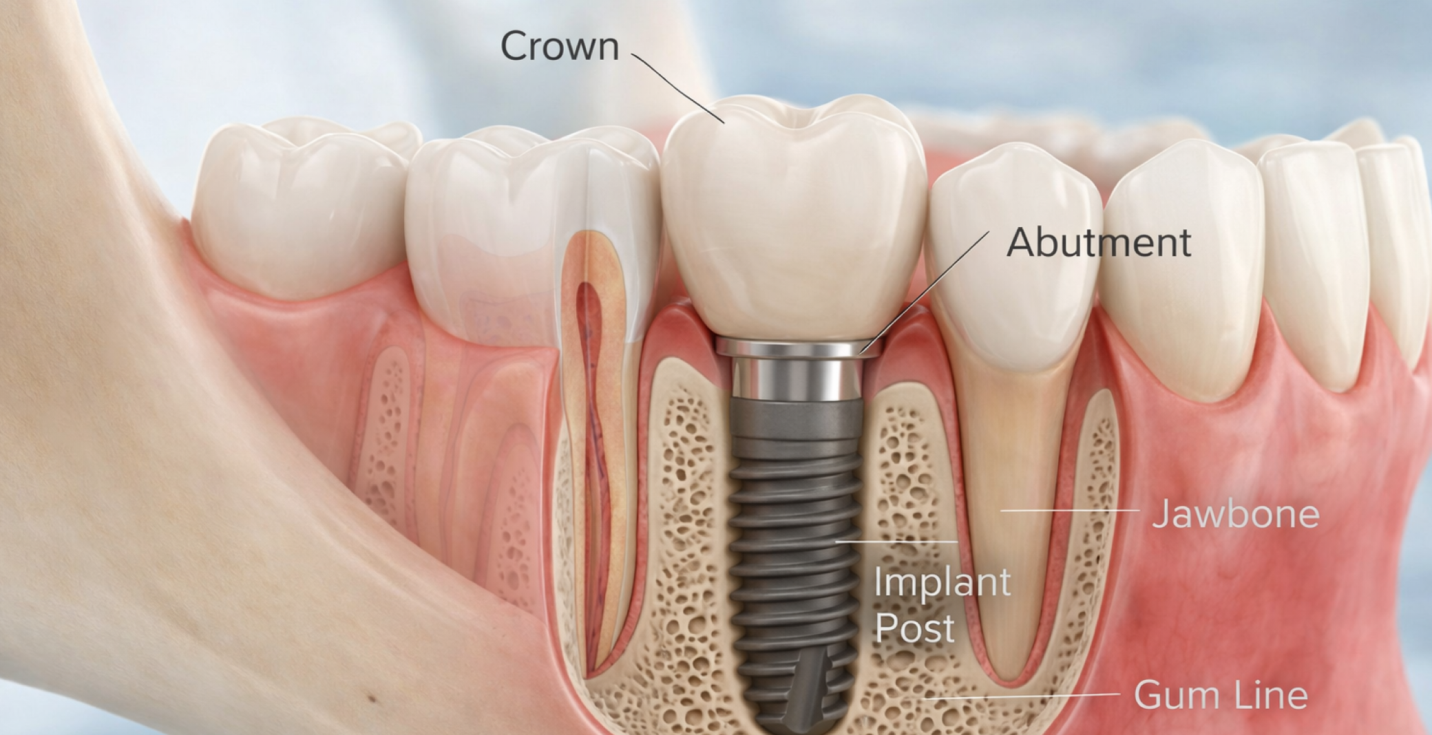 Cross-section illustration showing dental implant with crown, abutment, post, gum line, and jawbone structure.