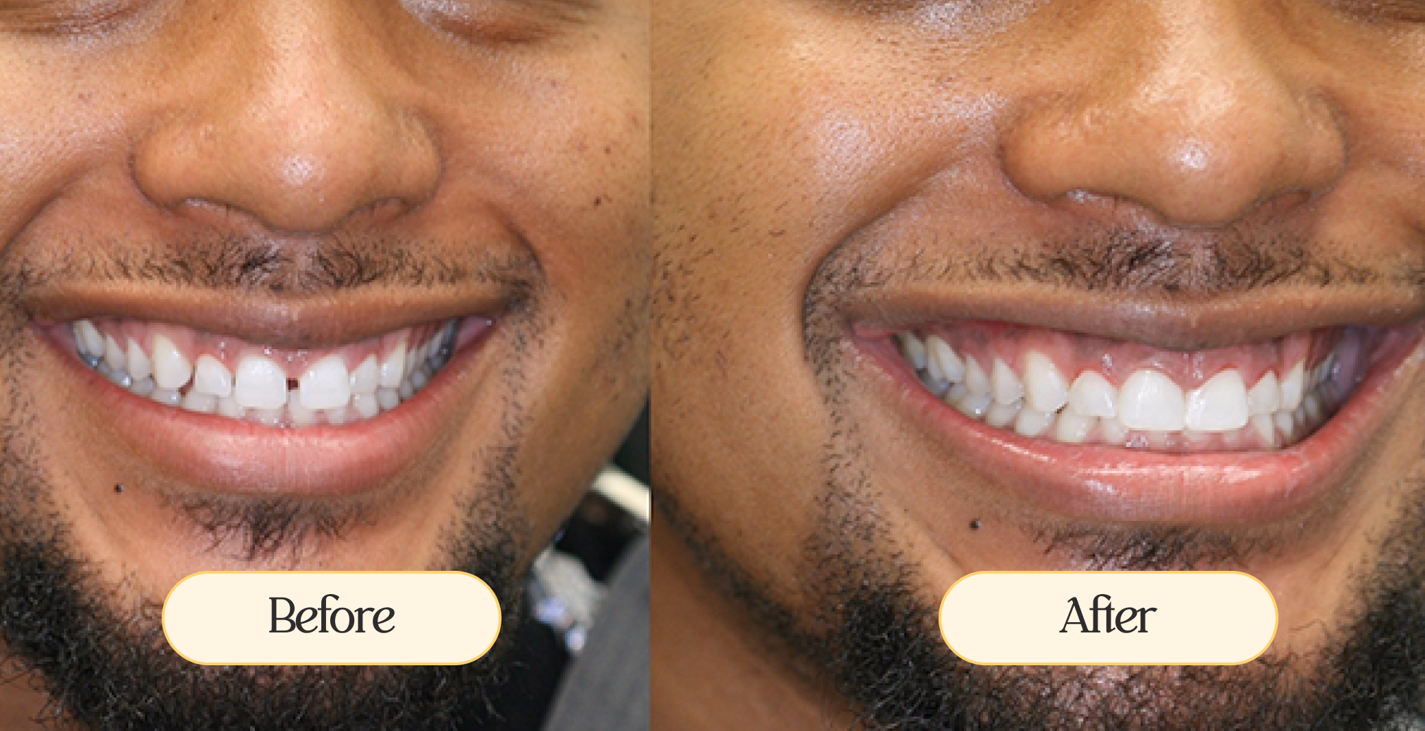 Before-and-after dental comparison showing a man's smile close-up, focusing on teeth gap closure and alignment.