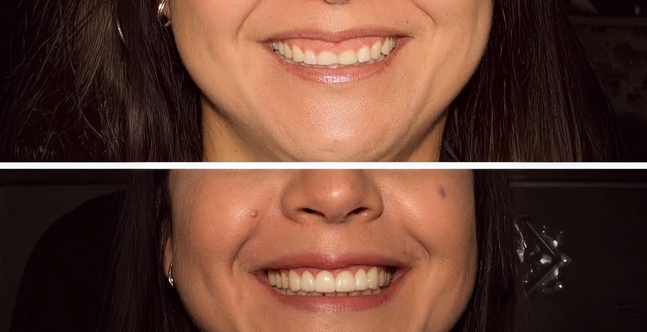 Before-and-after close-up of a woman's smile makeover, showing correction of a gummy smile and enhanced teeth shape.