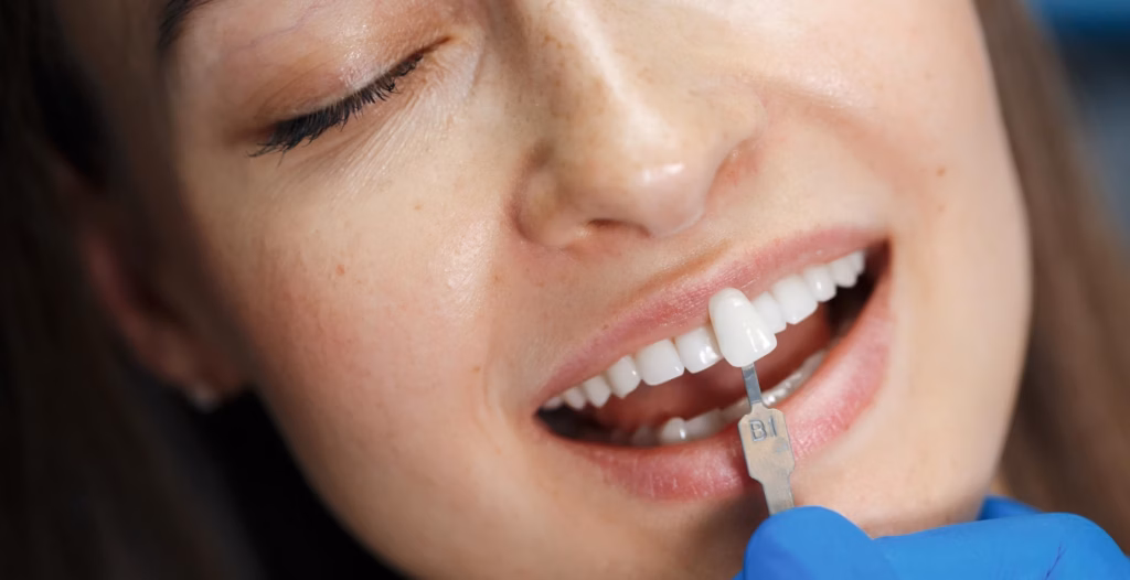 Close-up of a dentist checking a woman's tooth color shade using a dental shade guide.