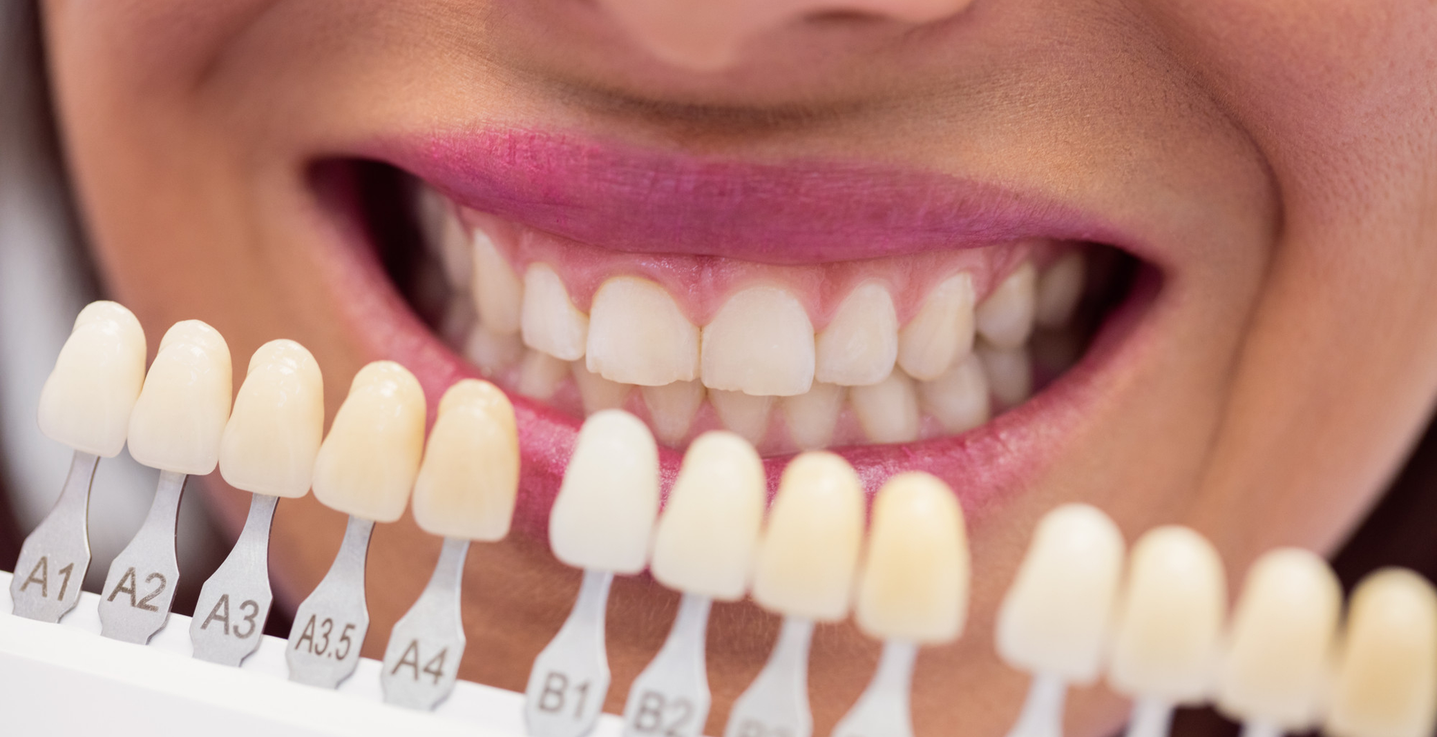 Close-up of mouth with dental shade guide showing tooth color samples for cosmetic dentistry